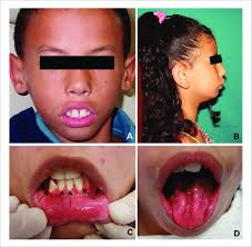 The patient can not smile, cry and express other emotions. Figure Oro Facial Characteristics Of Individuals With Moebius Download Scientific Diagram