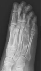 Tell the radiologist and/or technician if you have any metal fillings in your mouth or metal implants in your body, so they can make note of it and not confuse them with disease processes. Orthokids Unicameral Bone Cyst Ubc