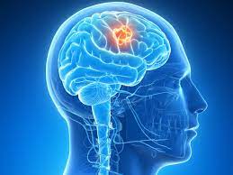 Mooci Hirntumor Das Sind Die Heilungschancen