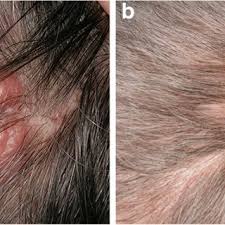 Clinical side effects include anxiety, fear. Clinical Picture Of A Primary Cutaneous Follicle Center Lymphoma Download Scientific Diagram