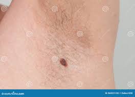 Precancerous Mole on Armpit - Birthmark is Potentially Cancerous Melanoma  Stock Photo - Image of defect, cosmetology: 260221102