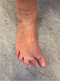 Image result for Hallux Varus