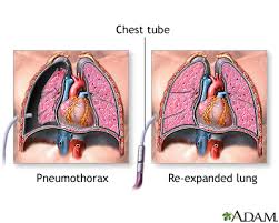 Consult a doctor for medical advice. Pneumothorax Series Incision Medlineplus Medical Encyclopedia