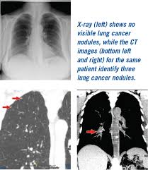 Ct scans can show a tumor's shape, size, and location. Lung Screening Program Ste Genevieve County Memorial Hospital