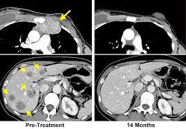 When breast cancer spreads to the liver it is common for women (and men) to experience generalized itching, which can be intense. New Approach To Immunotherapy Leads To Complete Response In Breast Cancer Patient Unresponsive To Other Treatments National Institutes Of Health Nih
