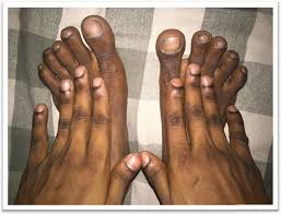 Image result for Clubbing nails feet