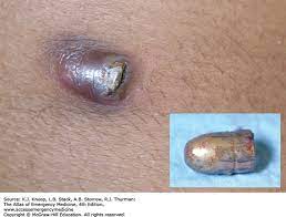It doesn't heal back to muscle, just scar tissue. Clinical Forensic Medicine Anesthesia Key