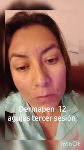 En mi caso es sin plasma, solo con crema regeneradora y humectante🤍🤍🤍