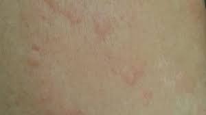 Hives Causes Risks Prevention And Pictures Allergic Reaction Hives Eczema Causes Hives Causes