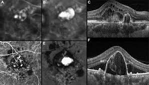 Polypoidal Choroidal Vasculopathy Consensus Nomenclature And Non Indocyanine Green Angiograph Diagnostic Criteria From The Asia Pacific Ocular Imaging Society Pcv Workgroup Sciencedirect
