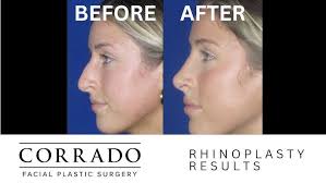 Rhinoplasty Experience: Patient Reveal and Reaction