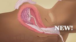This film explains what a retained placenta is, why it is important to be removed and the essential steps that need to be taken. Manual Removal Of The Placentaretrait Manuel Du Placenta Global Health Media Project