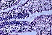 For other types of carcinoma in situ, routine screening and laboratory tests can detect precancer at an early stage. Carcinoma In Situ Wikipedia