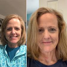 Ok, so I told you all that I had a lot of hair loss after a series of  surgeries. But I wanted to drive the point home about how much hair I