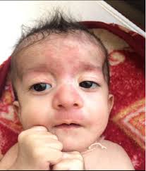 Hemangioma: A rare association of Escobar (Multiple pterygium) syndrome