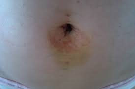 What is endometriosis at your incisional scar? Endometriosis Road To Mom