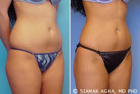 However, medicare may cover medically necessary liposuction when a doctor advises that the procedure may. Liposuction Cost In Orange County Orange County Coolsculpting