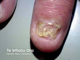 Image result for onychomycosis