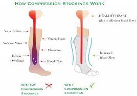 Compression Stockings People S Choice Drug Mart