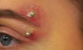 Most of these are pretty inconspicuous on their own. Piercing Infection The Complete Symptoms And Treatment Guide 2020