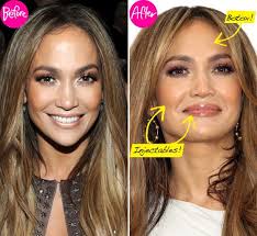 Stars Before After Botox Kim Kardashian J Lo More Do They Look Better Or Worse Botox Jennifer Lopez Plastic Surgery Botox Lips
