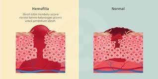 Our vision is to remove barriers to choice of treatment and to improve the care and quality of life for all people with bleeding disorders. Hemofilia Tanda Dan Gejala Penyebab Cara Mengobati Cara Mencegah