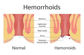 Image result for Hemorrhoid
