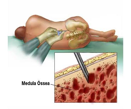 Resultado de imagem para TRANSPLANTE DE MEDULA ÓSSEA: O QUE É E PARA QUE SERVE?"