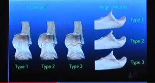 Image result for Coronoid Process Fracture