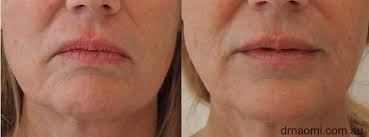 Maybe you would like to learn more about one of these? Dermal Filler To Improve Jowls Jawline And Sag In Lower Face Best Clinic Sydney For Dermal Fillers