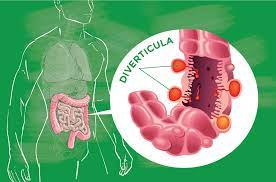 Understanding Diverticulitis And Why It S Affecting More Of Us Bio K