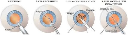 Image result for Cataract Extraction