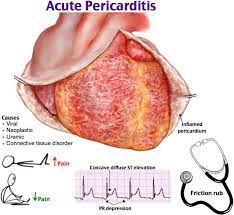 A pericardite aguda é uma inflamação súbita do pericárdio (a estrutura sacular flexível de camada dupla que envolve o coração), muitas vezes dolorosa, . Pericardite Aguda Articulos Intramed