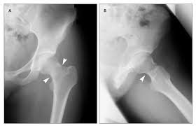 Is there too much stress in your life? A Completed Stress Fracture In A Marathon Runner Case Report