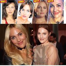 Check spelling or type a new query. Can You Recognize Her Meryem Uzerli Loses Original Face Features 4 Lip Operations And 3 For The Jaw Picture Al Bawaba