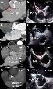 What does msct stand for? Cardiac Computed Tomography Compared With Two Dimensional Transesophageal Echocardiography For The Detection And Assessment Of Atrial Septal Pouches Springerlink