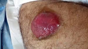 Image result for Merkel Cell Carcinoma