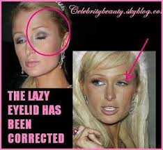 Paris Hilton S Eyelid Paris Hilton Hilton Eye Surgery