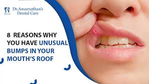 Image result for Canker sores symptoms roof of the mouth
