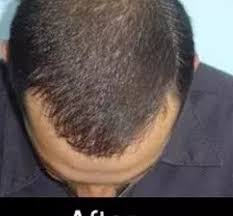 نتائج حقن بلازما الشعر Hair Injections Plasma