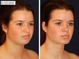 Best Neck Lift Surgeon Miami Dr Ramirez Plastic Surgeon Facial Implant Best Plastic Surgeons Chin Implant
