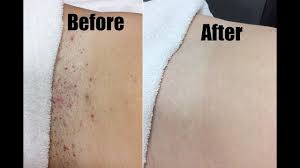 Sometimes, dead skin can clog up a hair follicle and sometimes cutting a naturally curly. Best Way To Remove Ingrown Hairs Permanently Get Rid Of Ingrown Hairs Youtube