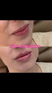 Instagram photo by Heather Marcel DeRoche, RN, Injector Artist Aesthetics •  Mar 18, 2025 at 7:56 AM