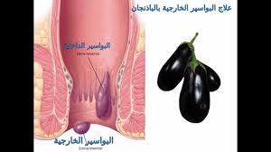 واخيرااا بحمد الله وصفة مجربة وعلاج نهائي للبواسير الداخلية والخارجية والقولون العلاج مع عمر Youtube Vegetables Food Eggplant