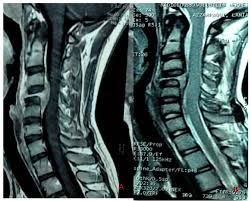 Image result for Spinal Infection