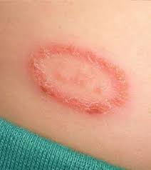Top 5 Types Of Skin Disease Caused By Fungus Fungal Infection Skin Yeast Infection Yeast Infection Causes