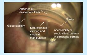 Image result for Gonioscopy