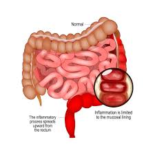 Image result for Ulcerative Colitis