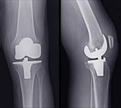 Sports And Exercise After Joint Replacement Total Knee Replacement Knee Surgery Knee Replacement