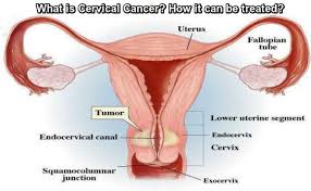 When cervical cancer is found early, it is highly treatable and associated with long survival and good quality of life. Homeopathy Treatment For Cervical Cancer In Mumbai Delhi Lucknow Expert Cancer Homoeo Clinic